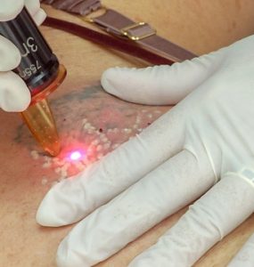 What To Expect After Laser Tattoo Removal